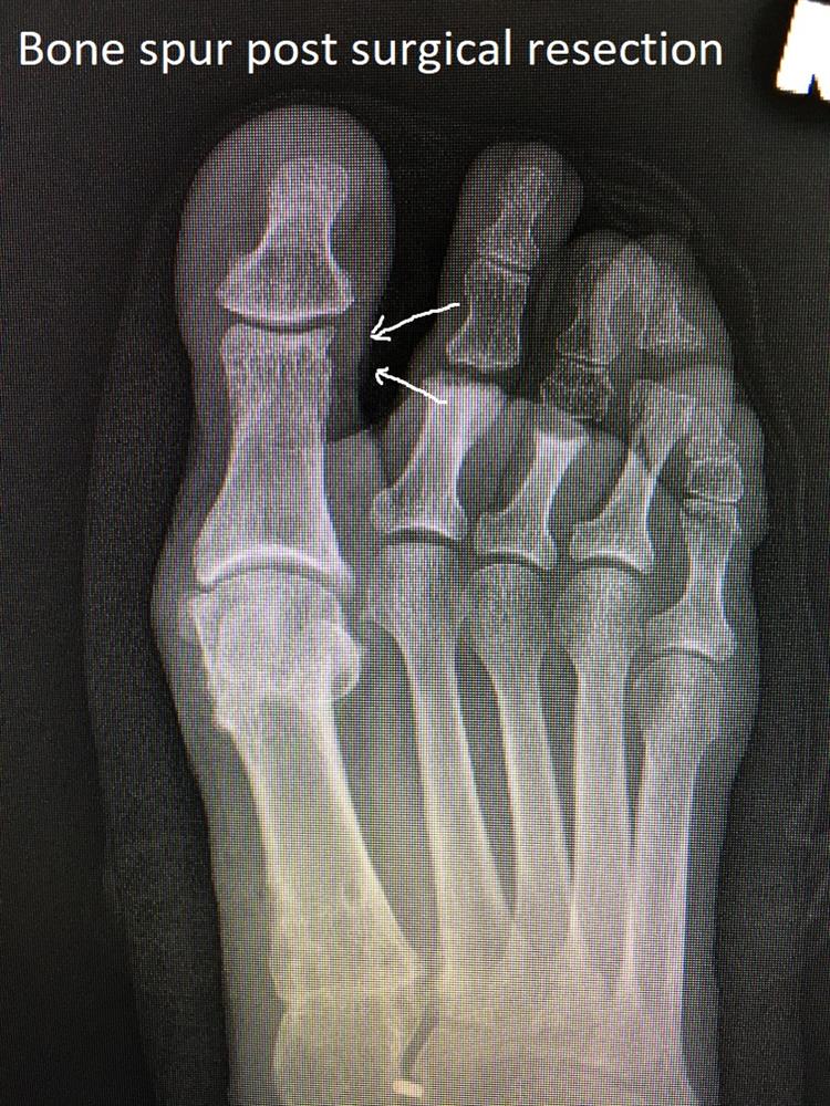 bone spur resection toe